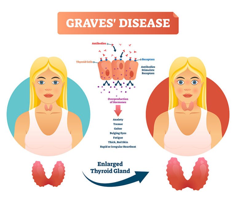 Symptoms Of Graves Disease Newstrendline Com